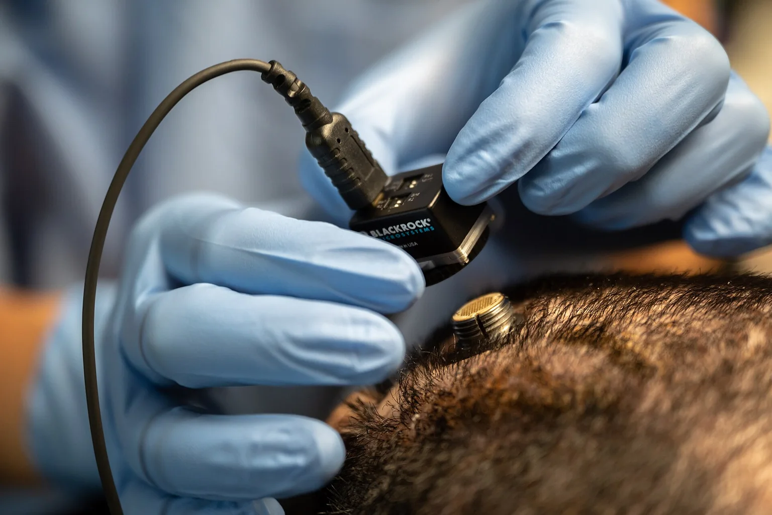 Gloved hands attach a cable connector to a brain implant port on a patient's scalp.